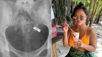 Woman accidentally swallows wedding ring while taking vitamins, X-ray shows